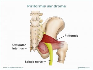 Piriformis-syndrome-web-large800x600